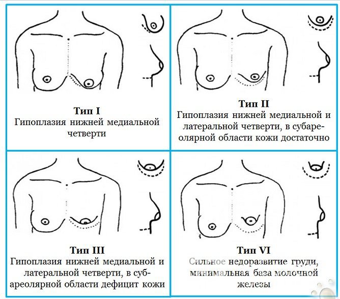 Первичная гипогалактия нередко обусловлена гипоплазией молочных желез