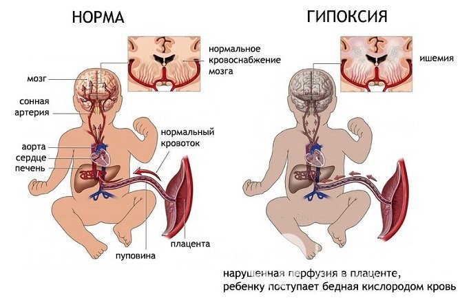 Признаки гипоксии плода