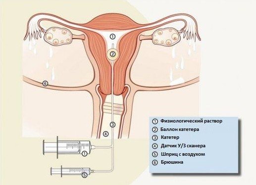 Методы диагностики гипоплазии матки