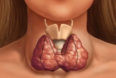 Гипоплазия щитовидной железы: симптомы и лечение