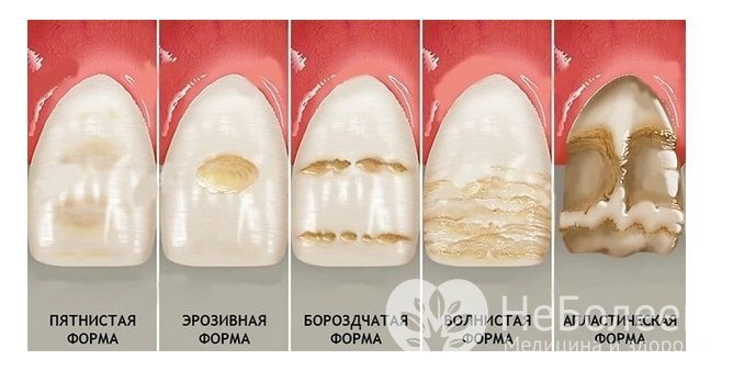 Гипоплазия зубной эмали