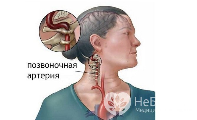 Гипоплазия позвоночной артерии