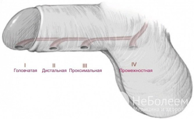 Гипоспадия: симптомы и лечение