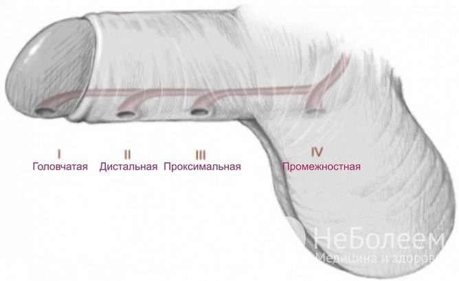 Гипоспадия: симптомы и лечение