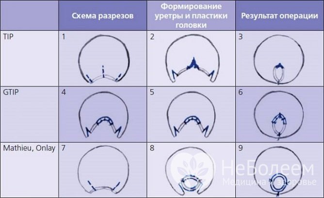 Варианты хирургического лечения гипоспадии