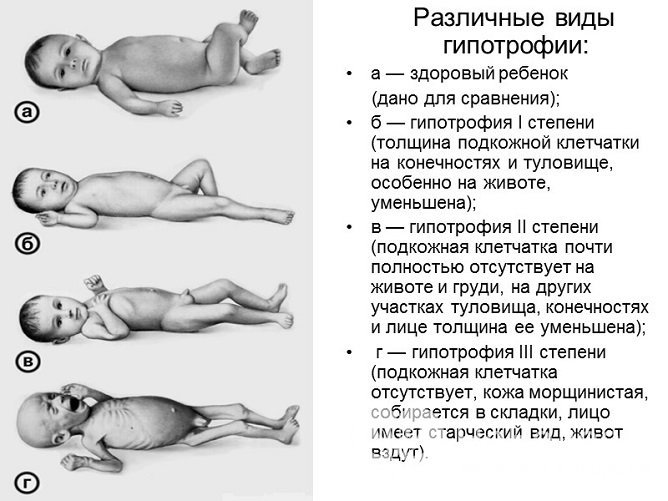 Степени гипотрофии