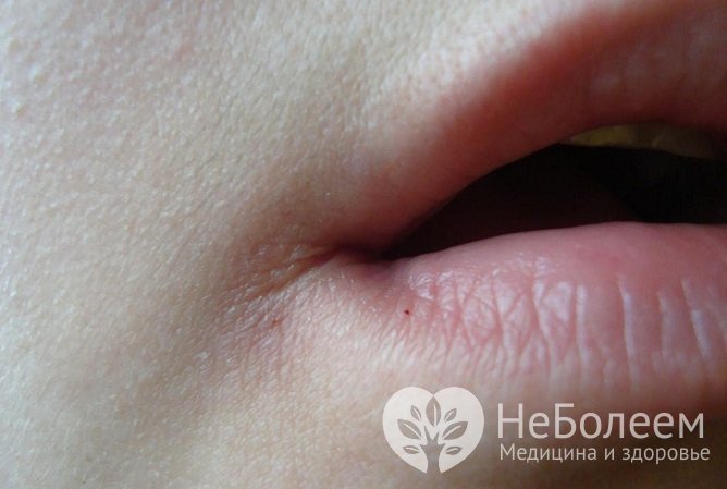 Трещинки в уголках губ сигнализируют о гиповитаминозе В6