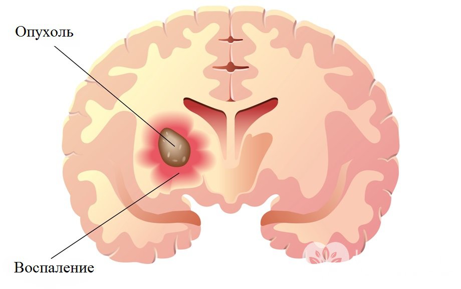 Глиома – опухоль мозга