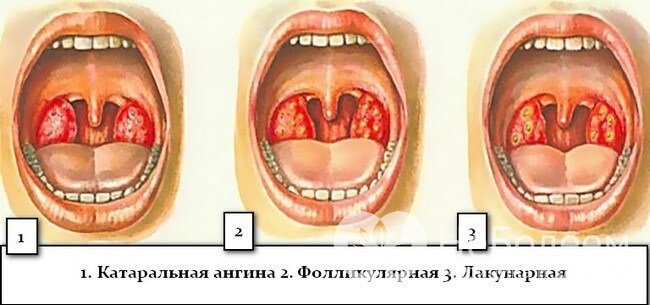 Виды гнойной ангины