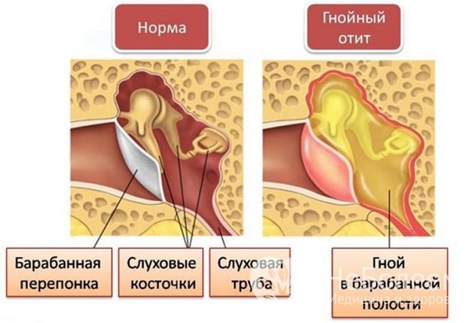 Гнойный отит: симптомы и лечение