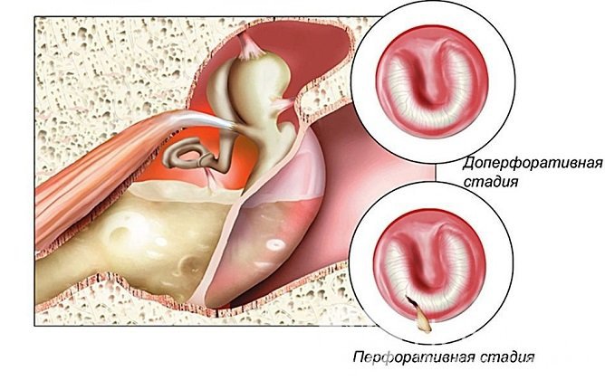 Стадии гнойного отита