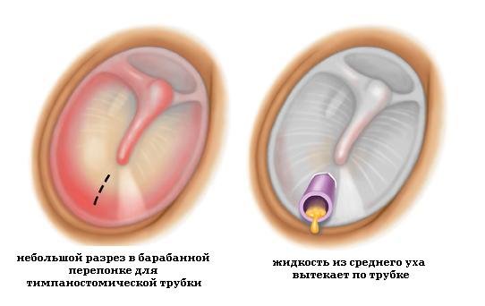 Парацентез при гнойном отите