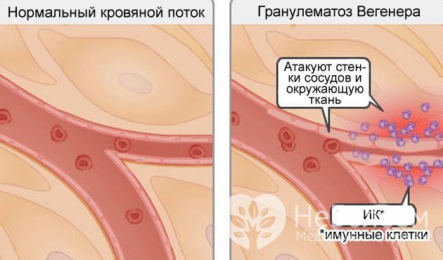 При гранулематозе Вегенера иммунные клетки атакуют стенки сосудов и окружающую ткань