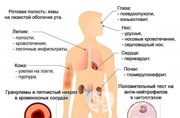 Симптомы гранулематоза Вегенера