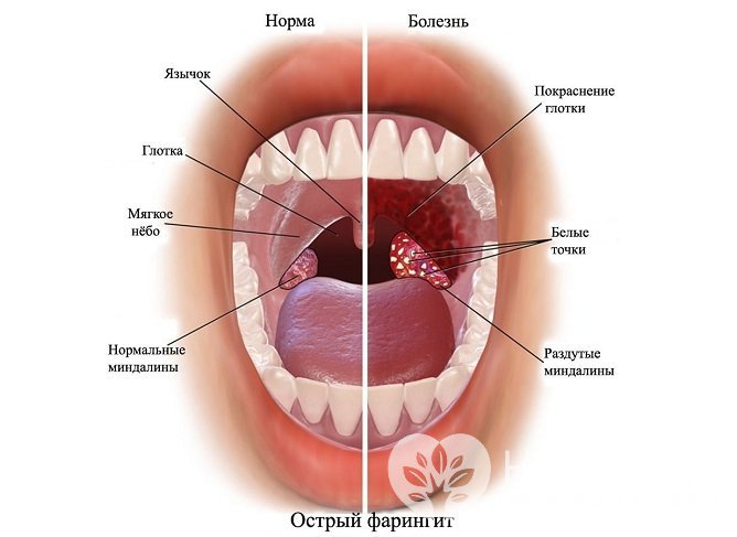 Симптомы острого фарингита