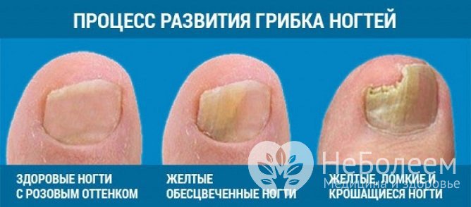Процесс развития грибка ногтей