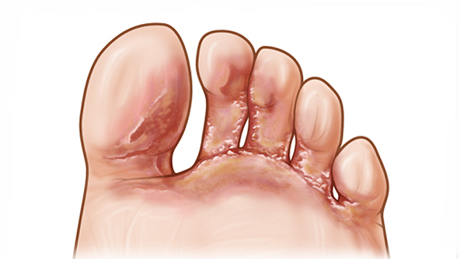 Грибок стопы в первую очередь поражает межпальцевые пространства