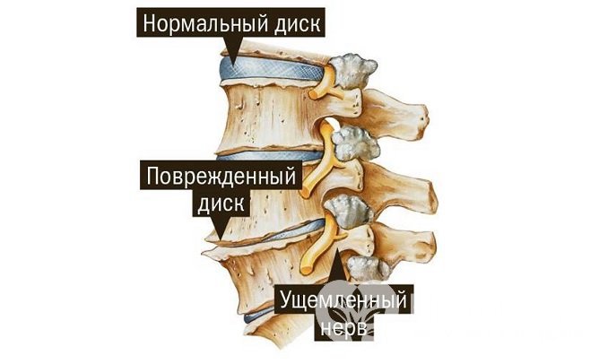 Причины грудного остеохондроза