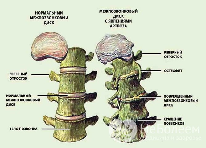 Остеофиты - осложнение грудного остеохондроза