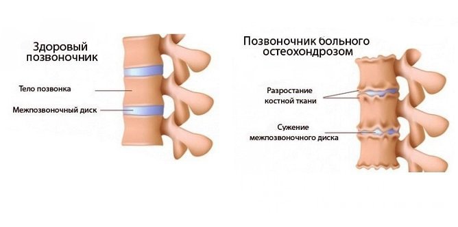 Симптомы грудного остеохондроза 