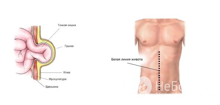 Признаки грыжи белой линии живота 
