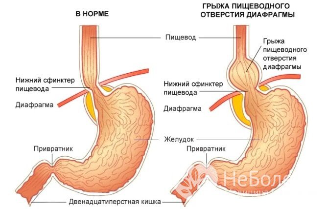 Грыжа пищевода: симптомы и лечение