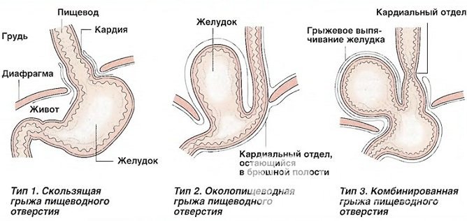 Виды грыжи пищеводного отверстия диафрагмы