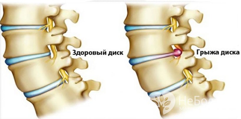 Признаки грыжи поясничного отдела позвоночника 