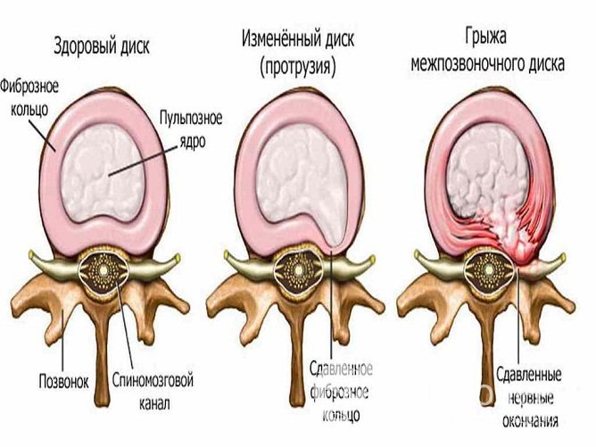 Этапы развития грыжи поясничного отдела позвоночника