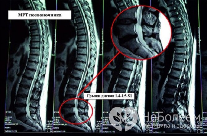 Грыжа поясничного отдела позвоночника на МРТ