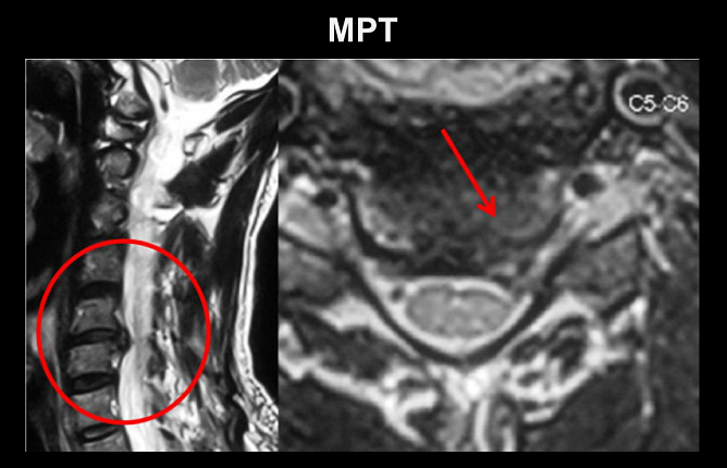 Грыжа шейного отдела С5-С6 на МРТ