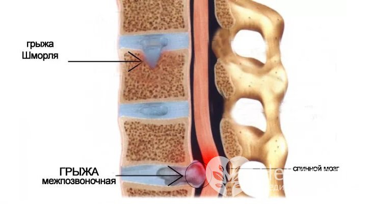 Симптомы грыжи Шморля