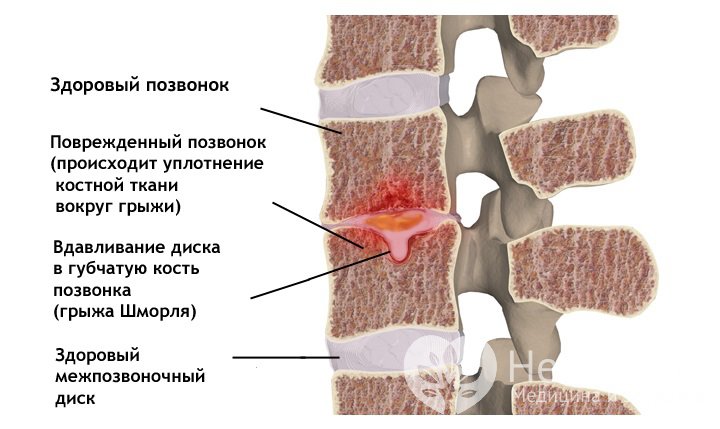 Признаки грыжи Шморля