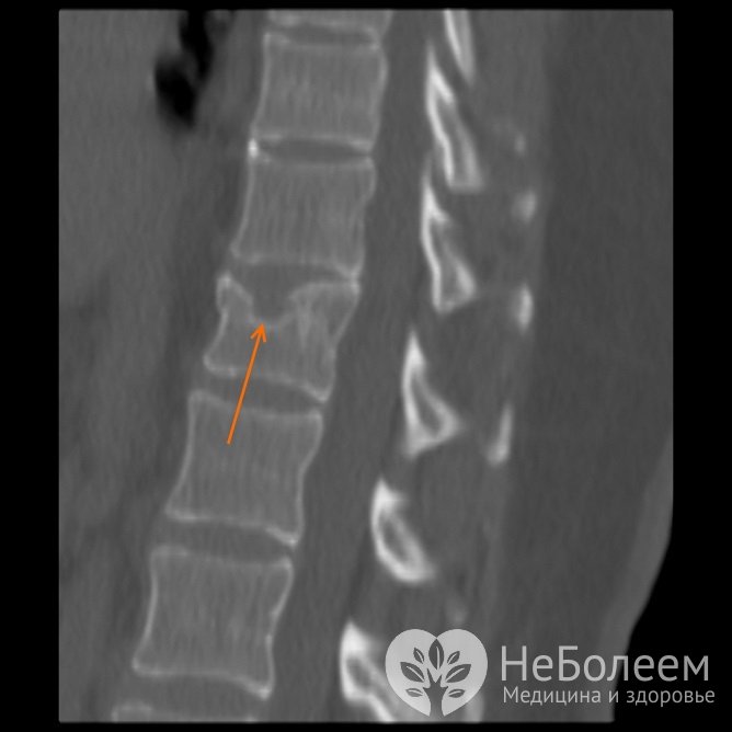 Грыжа Шморля на рентгеновском снимке