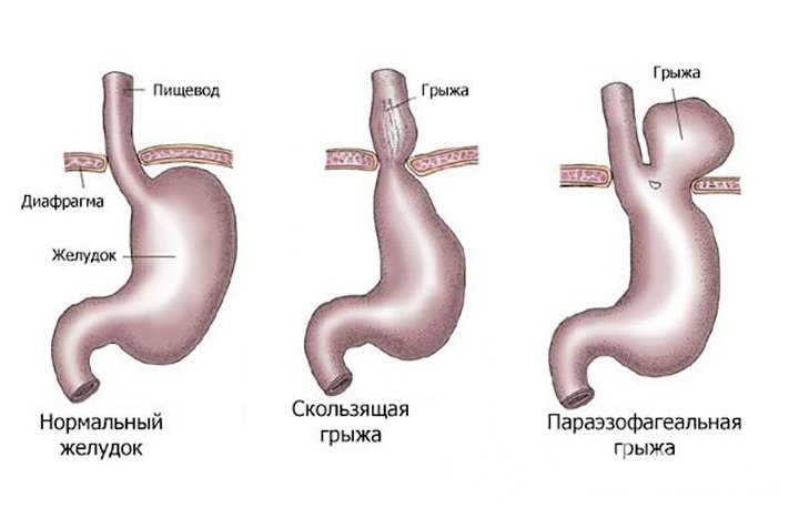 Диафрагмальный пищевода. Грыжа 2 степени желудка. Грыжа пищеварительного отверстия диафрагмы. Грыжа желудка 1 степени. Кардиальная грыжа пищевода.