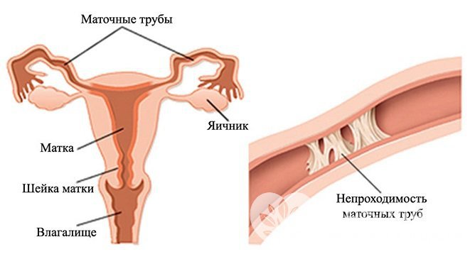 Последствием хламидиоза у женщин могут стать спайки в маточных трубах, вызывающие проблемы с зачатием