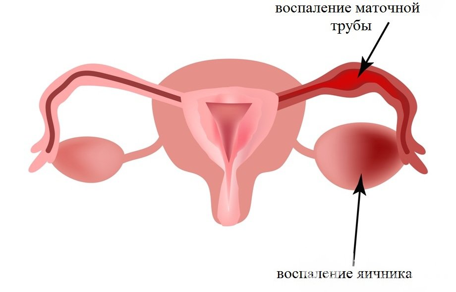 Признаки хронического аднексита