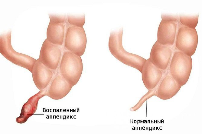 Основная причина хронического аппендицита – вяло текущий инфекционный процесс