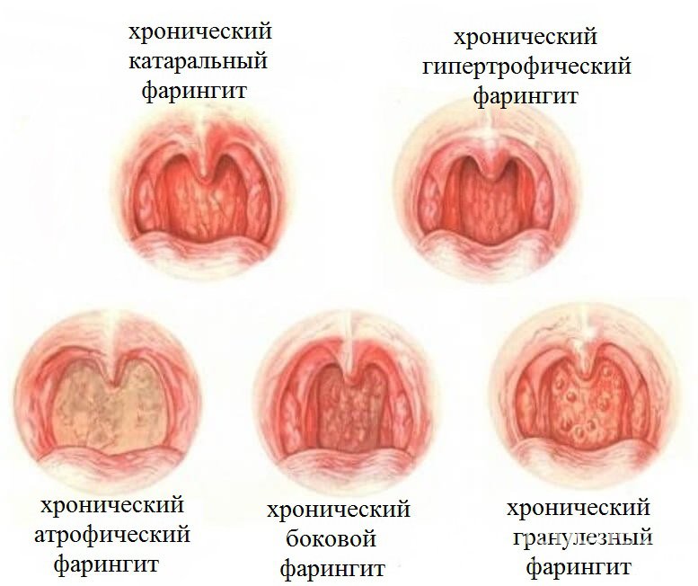 Признаки хронического фарингита