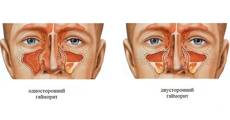 Симптомы и виды хронического гайморита