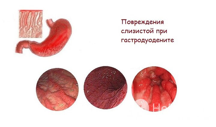 Признаки хронического гастродуоденита 