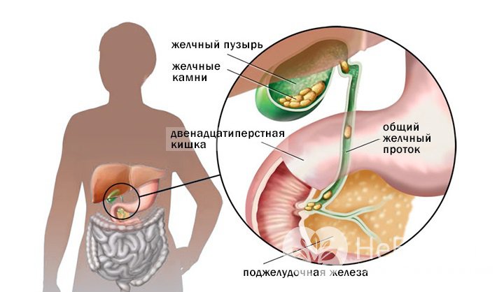 Признаки хронического холецистита