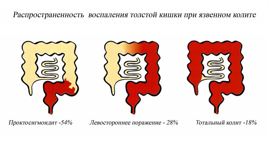 Признаки хронического колита