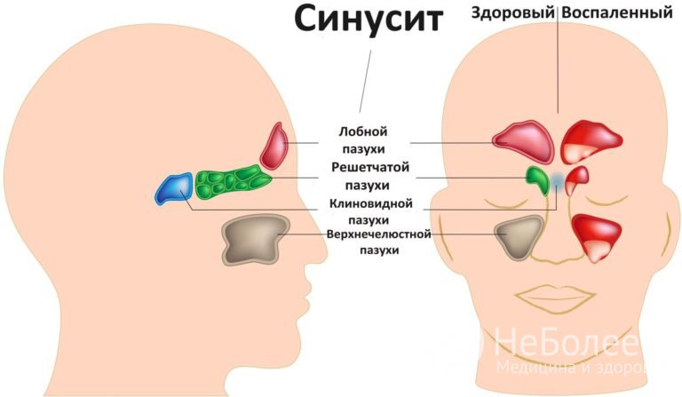 Признаки хронического синусита