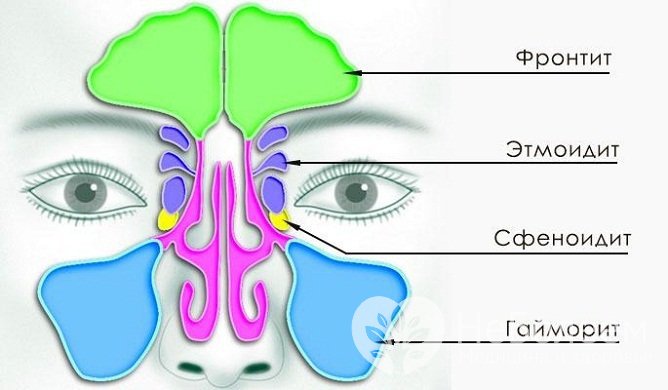 Виды хронического синусита