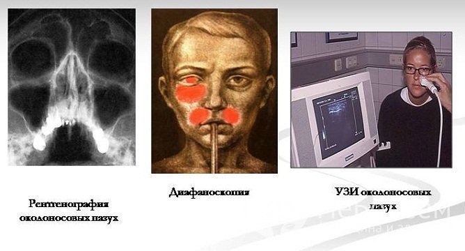 Диагностика хронического синусита