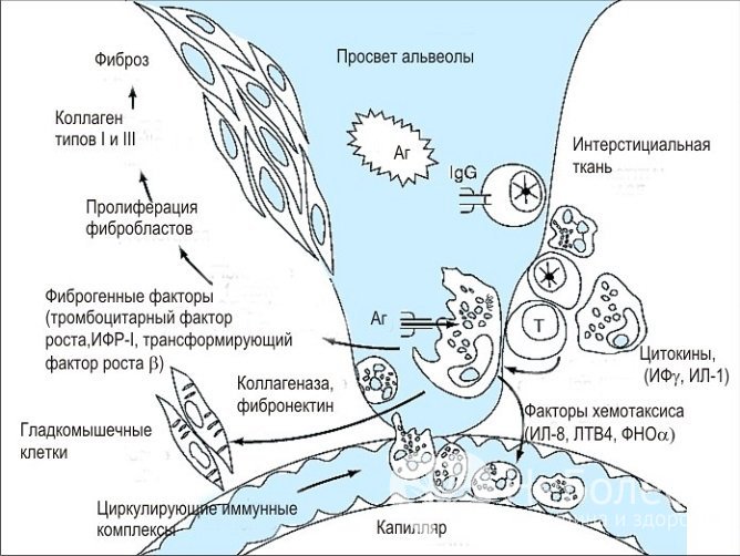 Патогенез идиопатического фиброзирующего альвеолита