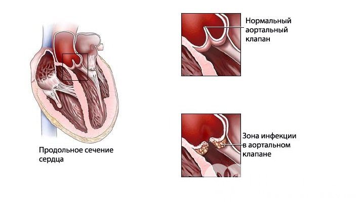 Признаки инфекционного эндокардита