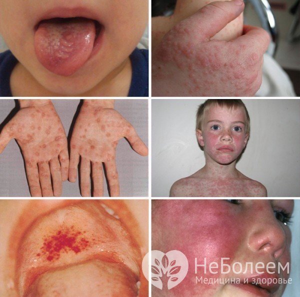Сыпь – один из симптомов инфекционного мононуклеоза у детей