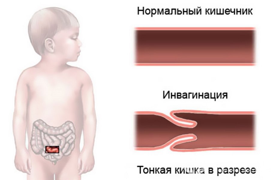 Признаки инвагинации кишечника